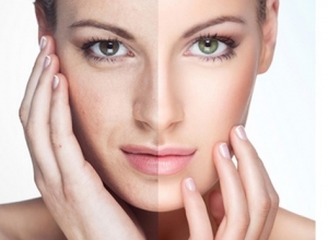 Nám da có trị hết hẳn được không?